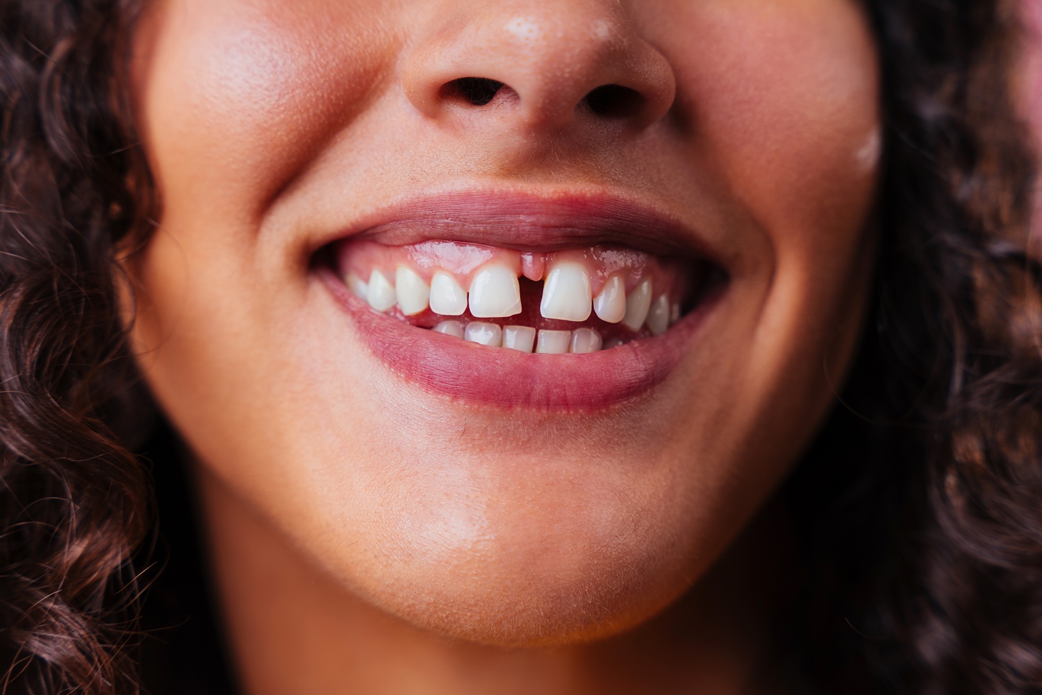 Corrección de diastema con tratamiento de estética dental