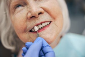 Procedimiento de estética dental para aclarar el tono de los dientes